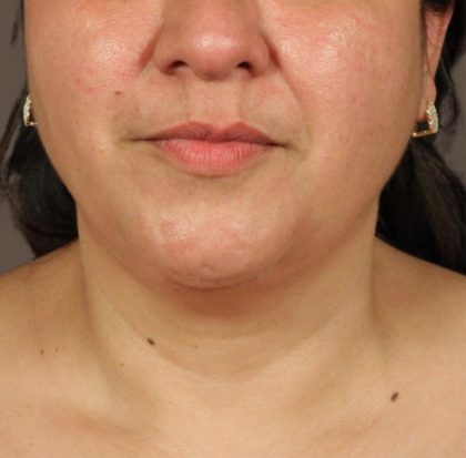 Neck Lift Before & After Patient #3671