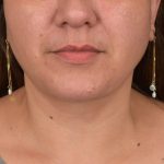 Neck Lift Before & After Patient #3671