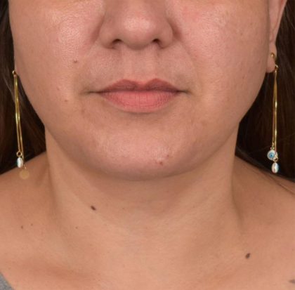 Neck Lift Before & After Patient #3671