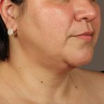 Neck Lift Before & After Patient #3671