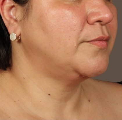 Neck Lift Before & After Patient #3671