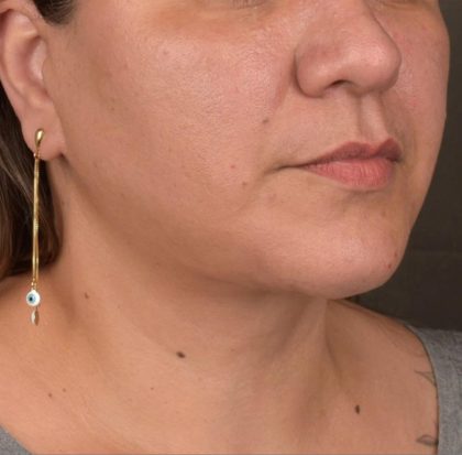 Neck Lift Before & After Patient #3671