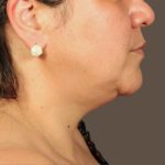 Neck Lift Before & After Patient #3671