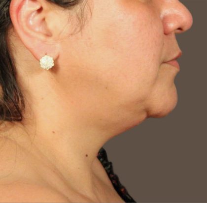 Neck Lift Before & After Patient #3671