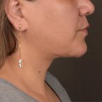 Neck Lift Before & After Patient #3671
