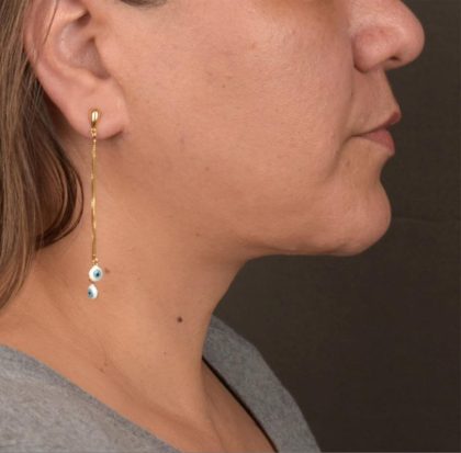 Neck Lift Before & After Patient #3671