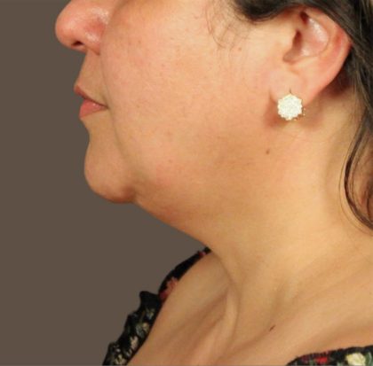 Neck Lift Before & After Patient #3671