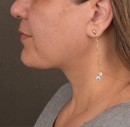 Neck Lift Before & After Patient #3671