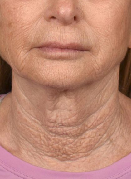 Neck Lift Before & After Patient #3817
