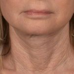 Neck Lift Before & After Patient #3817