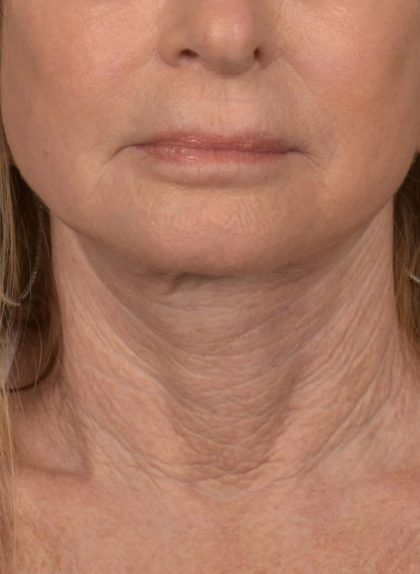 Neck Lift Before & After Patient #3817