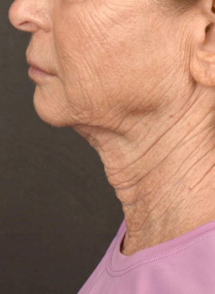 Neck Lift Before & After Patient #3817