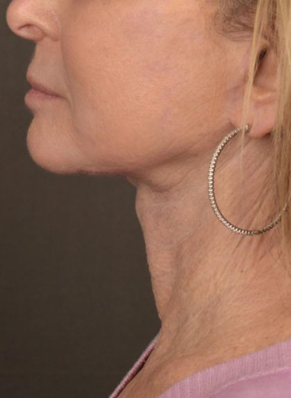 Neck Lift Before & After Patient #3817