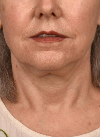 Neck Lift Before & After Patient #3820