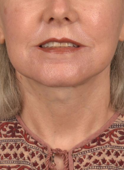 Neck Lift Before & After Patient #3820