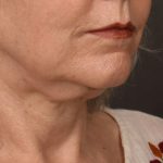 Neck Lift Before & After Patient #3820