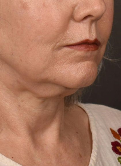 Neck Lift Before & After Patient #3820