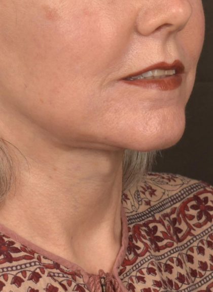 Neck Lift Before & After Patient #3820