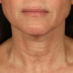 Neck Lift Before & After Patient #3819