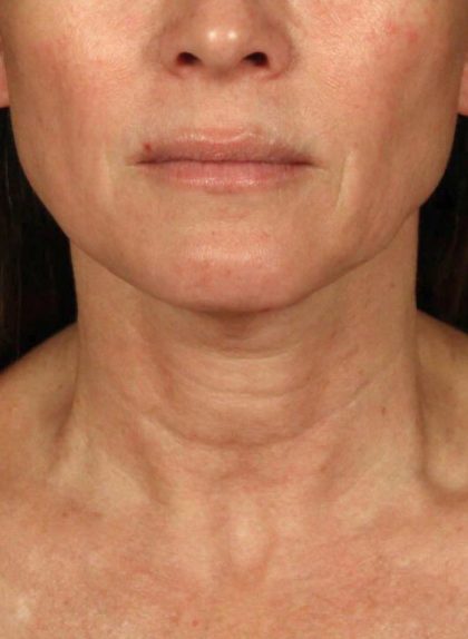 Neck Lift Before & After Patient #3819