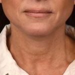 Neck Lift Before & After Patient #3819