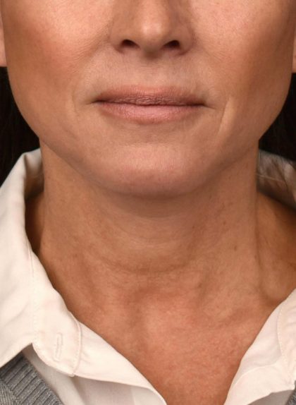 Neck Lift Before & After Patient #3819