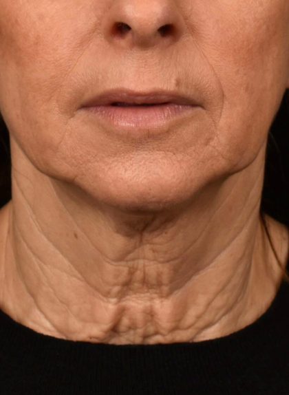 Neck Lift Before & After Patient #3819