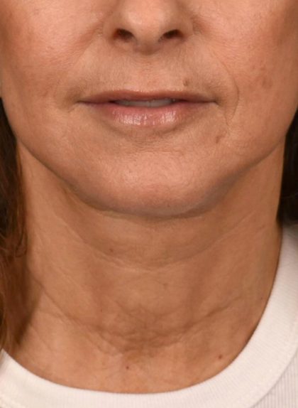 Neck Lift Before & After Patient #3819