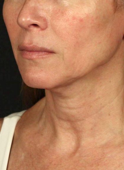 Neck Lift Before & After Patient #3819