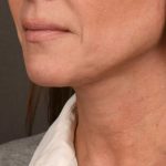 Neck Lift Before & After Patient #3819