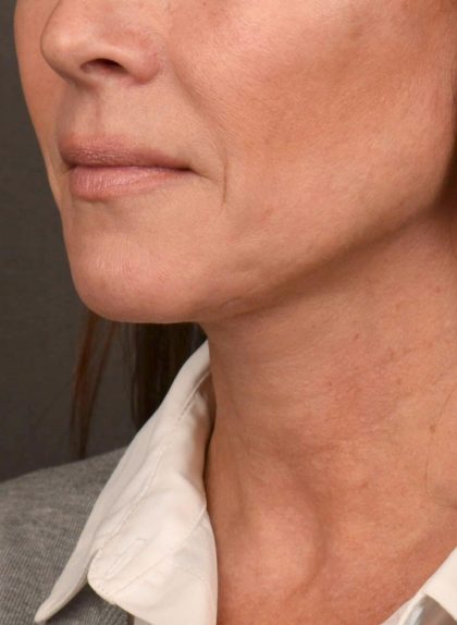 Neck Lift Before & After Patient #3819