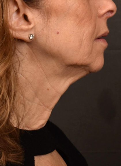 Neck Lift Before & After Patient #3819