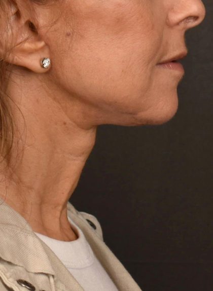 Neck Lift Before & After Patient #3819