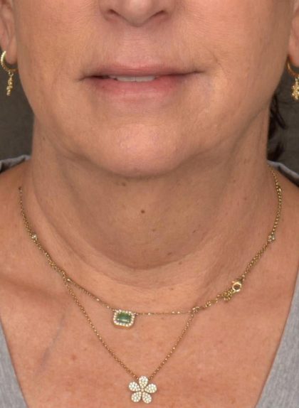 Neck Lift Before & After Patient #3818