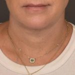 Neck Lift Before & After Patient #3818