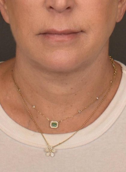 Neck Lift Before & After Patient #3818