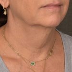 Neck Lift Before & After Patient #3818