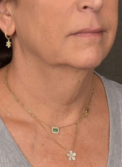 Neck Lift Before & After Patient #3818