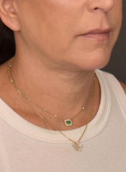 Neck Lift Before & After Patient #3818