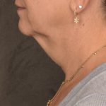 Neck Lift Before & After Patient #3818