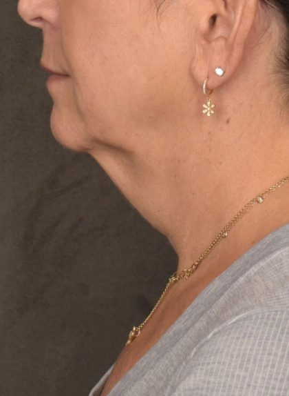Neck Lift Before & After Patient #3818