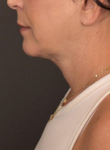 Neck Lift Before & After Patient #3818