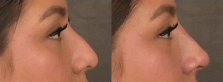 Non Surgical Rhinoplasty