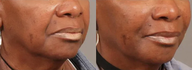 Softening of Facial Creases Wrinkles