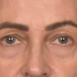 Blepharoplasty Before & After Patient #4134