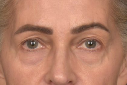 Blepharoplasty Before & After Patient #4134