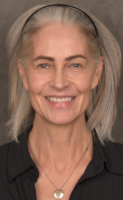 Facelift Before & After Patient #4123