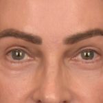 Blepharoplasty Before & After Patient #4134