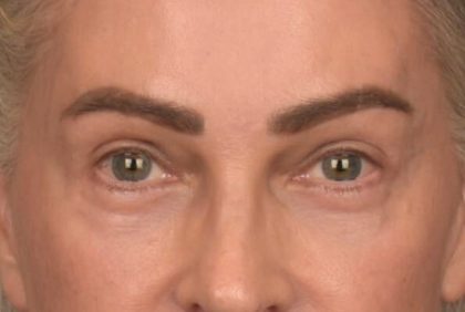 Blepharoplasty Before & After Patient #4134
