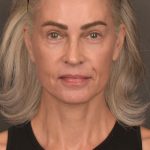 Facelift Before & After Patient #4123
